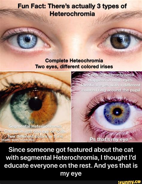 Central heterochromia (two different eye colors): .